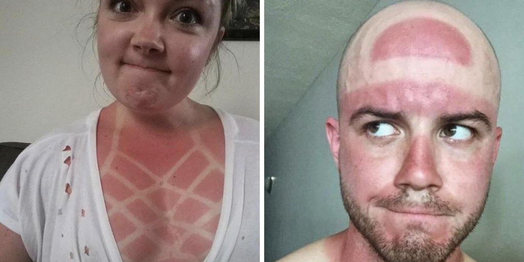 Bei diesen Sonnenbrand-Bildern glüht unsere Haut allein schon beim Anschauen