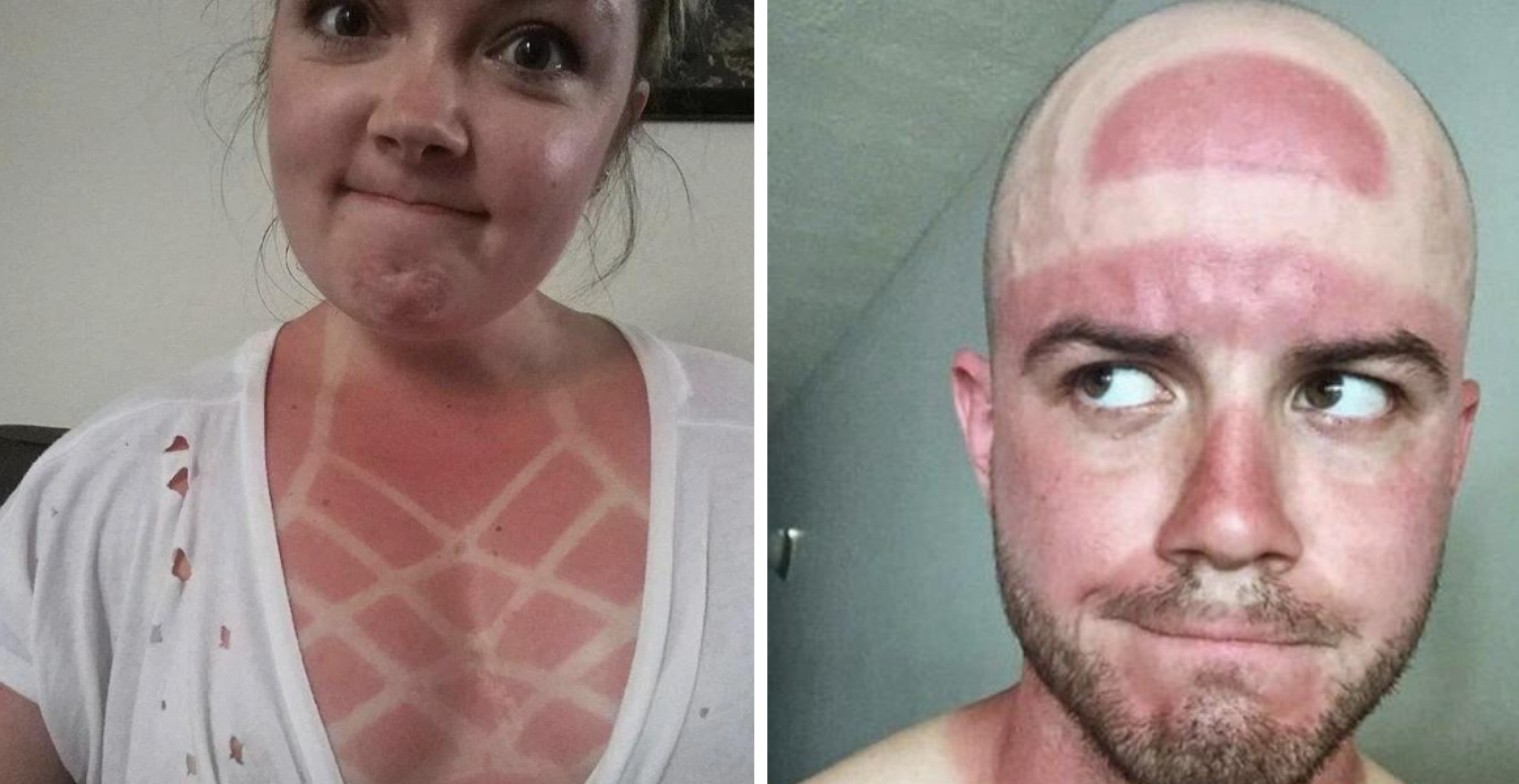 Bei diesen Sonnenbrand-Bildern glüht unsere Haut allein schon beim Anschauen